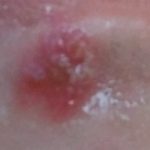 【注意】風邪を引いたときにニンニクを食べすぎると逆に体調が悪くなる「ヘルペス」の危険 【注意】風邪を引いたときにニンニクを食べすぎると逆に体調が悪くなる「ヘルペス」の危険